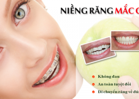 NIỀNG RĂNG MẮC CÀI