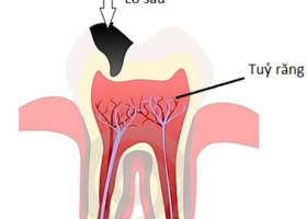 QUY TRÌNH NỘI NHA, CHỮA TỦY RĂNG